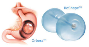 orbera gastric procedure