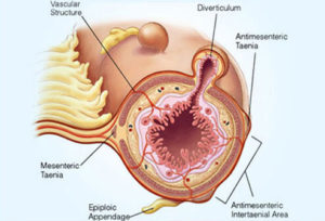 diverticulitis on the rise